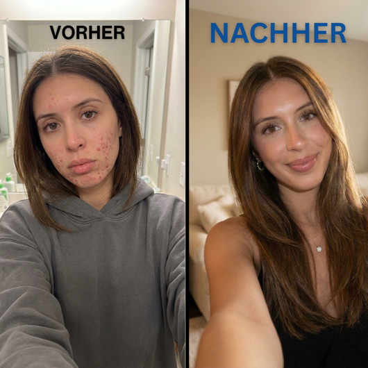 easySkin | Anti-Akne Gesichtstücher