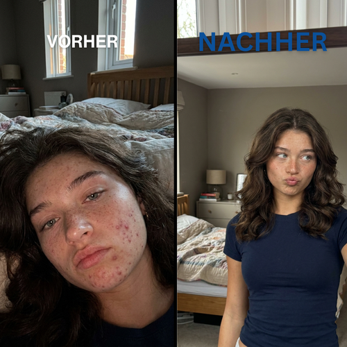 easySkin | Anti-Akne Gesichtstücher